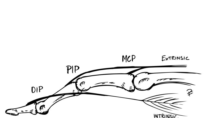 Svart och vit bild över mekanism bakom knapphålsdeformitet: Intrinsicsenans ”fäste” har lossnat från PIP-leden och luxerat volart. Detta resulterar i att istället verkar som en flexor i PIP-leden. Ökad tension i senan leder till hyperextension i DIP-led.