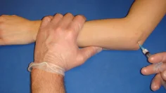 Leden mellan radius och humerus når man lättast genom att införa nålen i medial riktning omedelbart distalt om humerus laterala epikondyl och proximalt om radius.