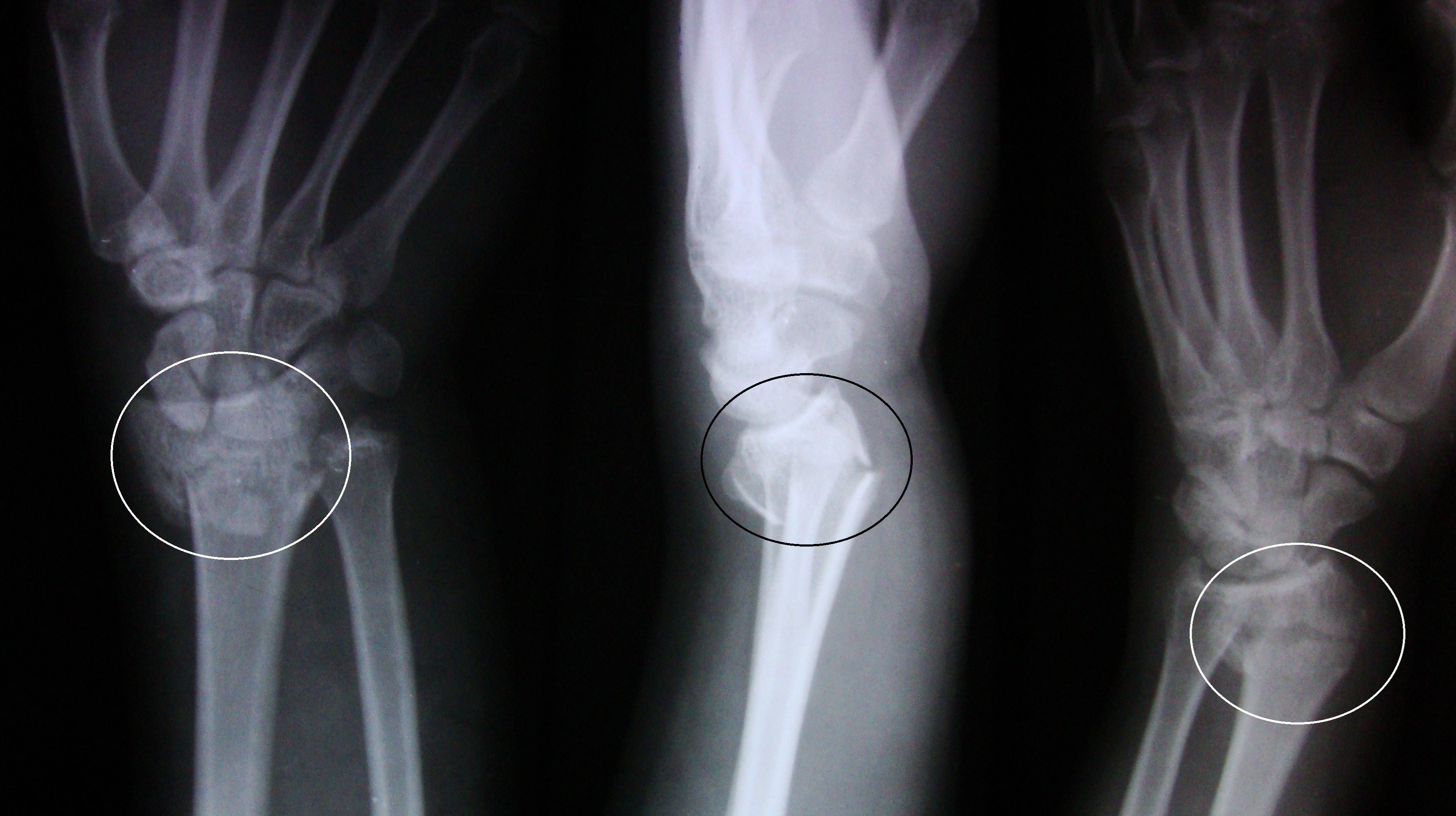 En röntgenbild av en distal radius fraktur som visar den karakteristiska Colles fraktur med förskjutning och vinkling av den distala änden av radien.