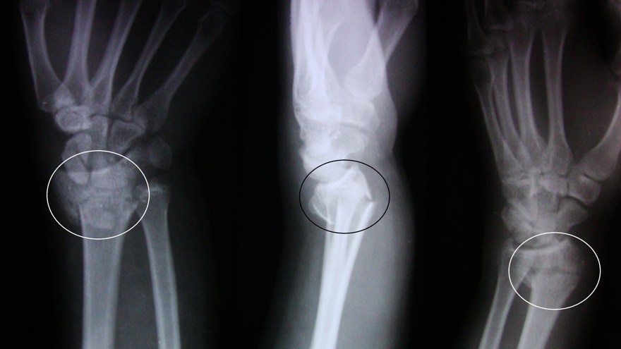 En röntgenbild av en distal radius fraktur som visar den karakteristiska Colles fraktur med förskjutning och vinkling av den distala änden av radien.