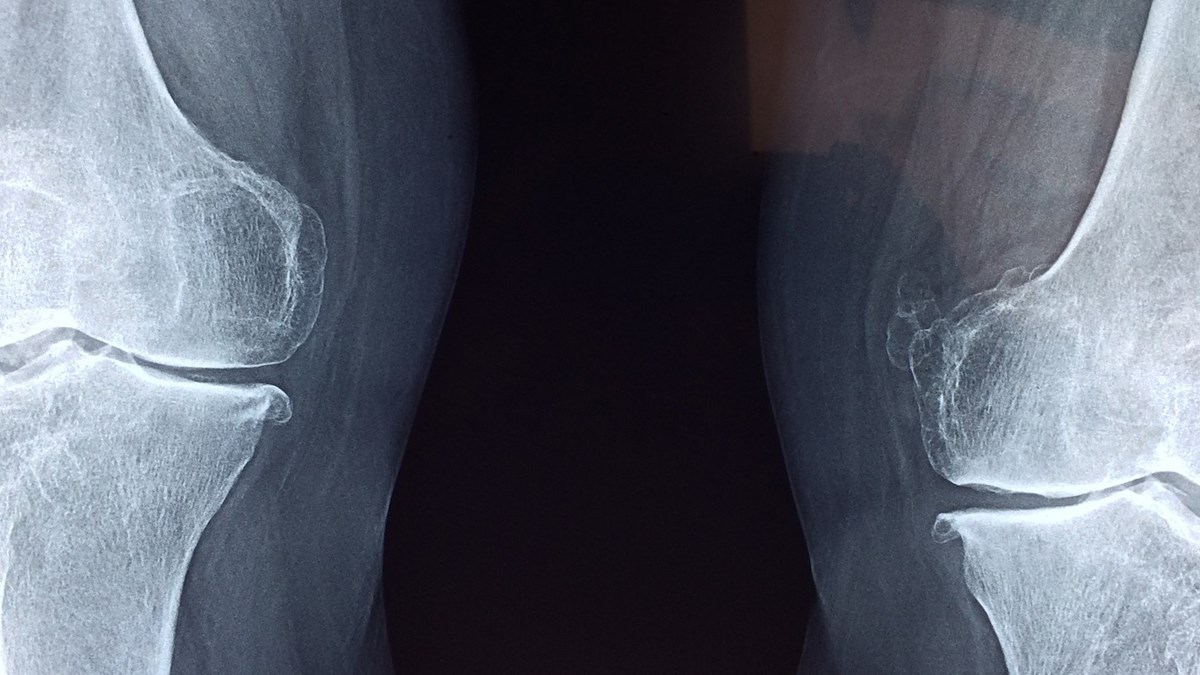 Röntgenbild i svartvitt som visar en persons knän.
