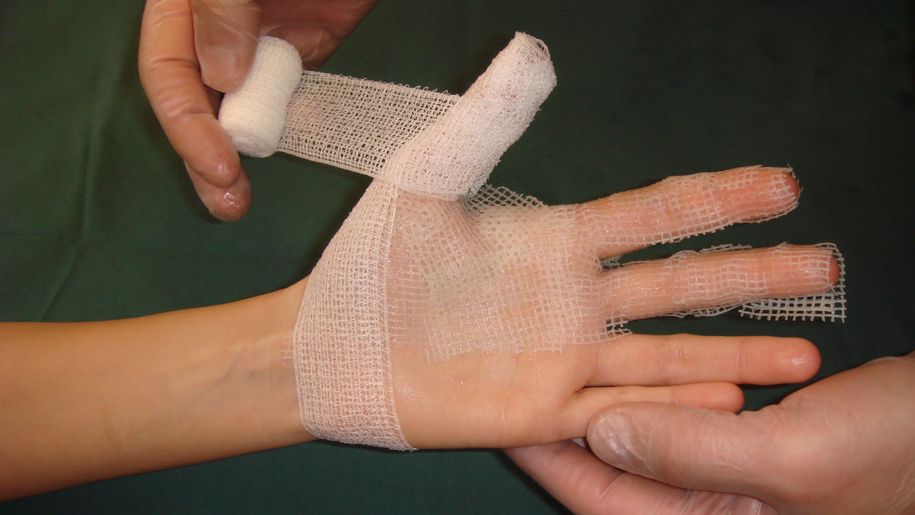 Ovanpå salvkompressen lindas ett lager med bonacrep linda, tillräckligt för att täcka men inte så tjockt att det inskränker för mycket i fingrarnas rörlighet.