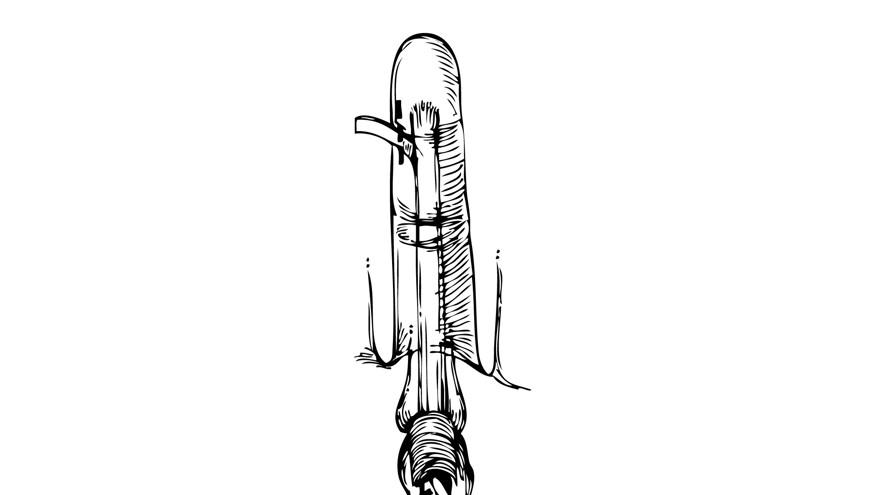 Svart och vit illustration över genomspolning av senskidan