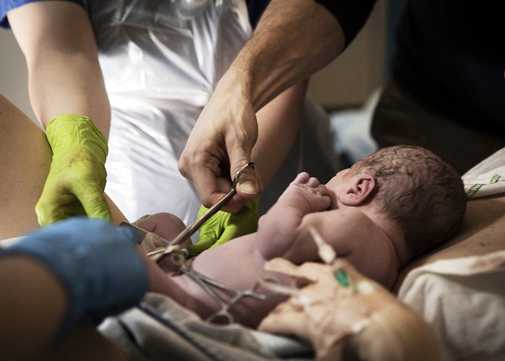 A new born having its umbellical cord cut.