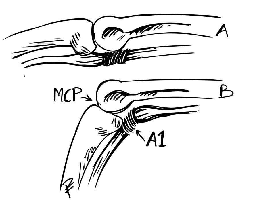 Svart och vit bild över triggerfinger mekanism. Bild A: Flexorsenan är förtjockad och uppdrivningen ligger distalt om A1 ligamentet vid extenderat läge. Bild B: Vid flexion drivs förtjockningen genom A1 ligamentet ”där den sedan hakar upp sig”, patienten upplever sedan ett tydligt ”släpp” då fingret åter rätas ut.