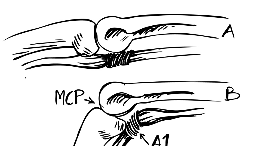 Svart och vit bild över triggerfinger mekanism. Bild A: Flexorsenan är förtjockad och uppdrivningen ligger distalt om A1 ligamentet vid extenderat läge. Bild B: Vid flexion drivs förtjockningen genom A1 ligamentet ”där den sedan hakar upp sig”, patienten upplever sedan ett tydligt ”släpp” då fingret åter rätas ut.