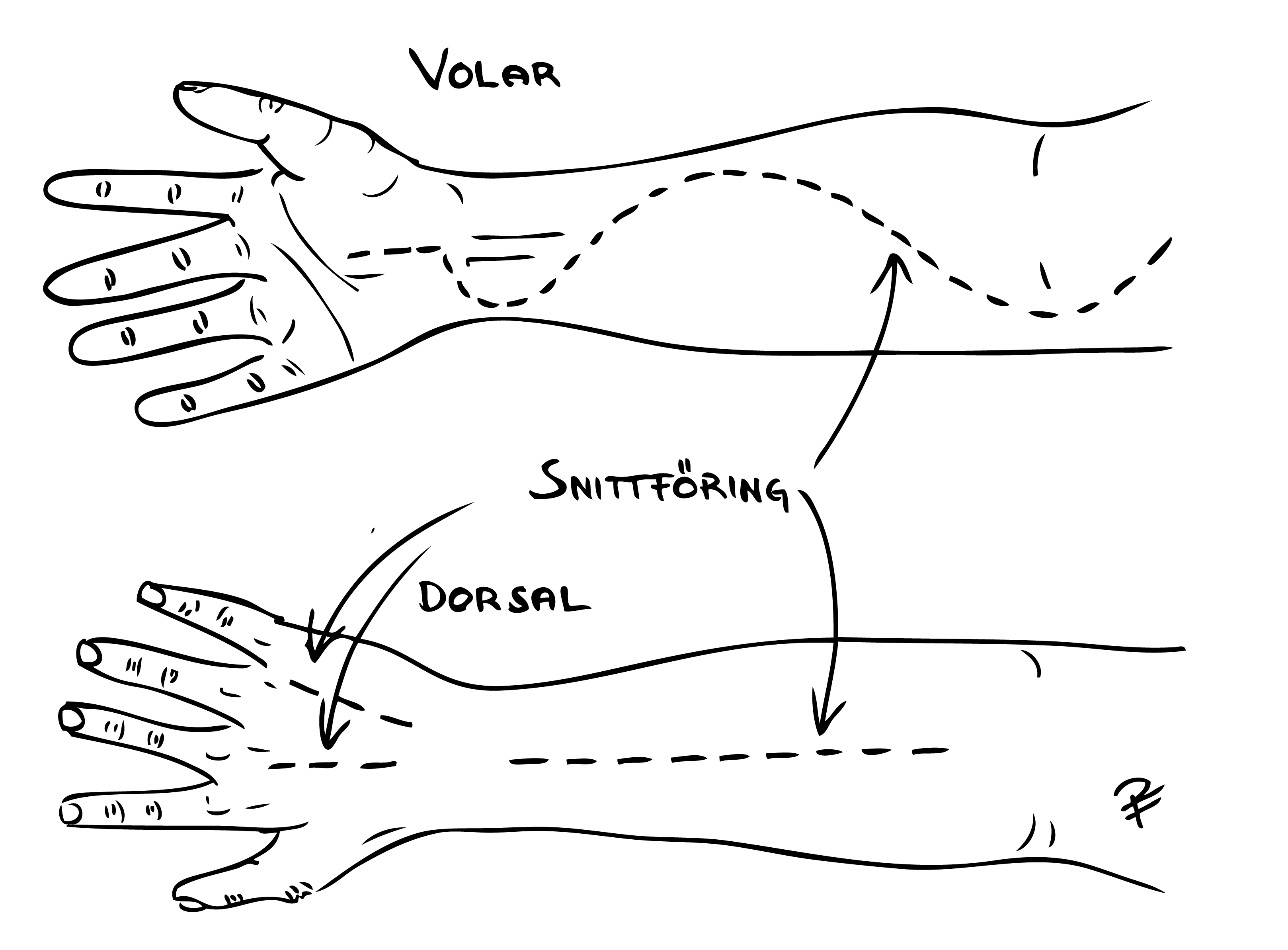 Svart och vitt diagram som visar kirurgisk fasciotomi