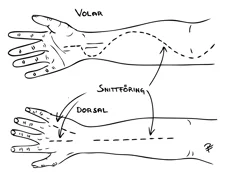 Svart och vitt diagram som visar kirurgisk fasciotomi