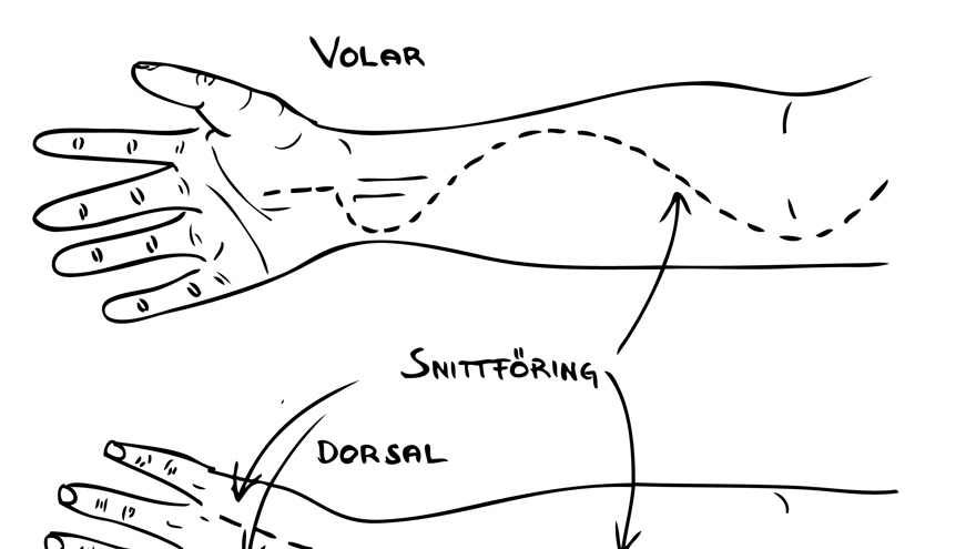 Svart och vitt diagram som visar kirurgisk fasciotomi