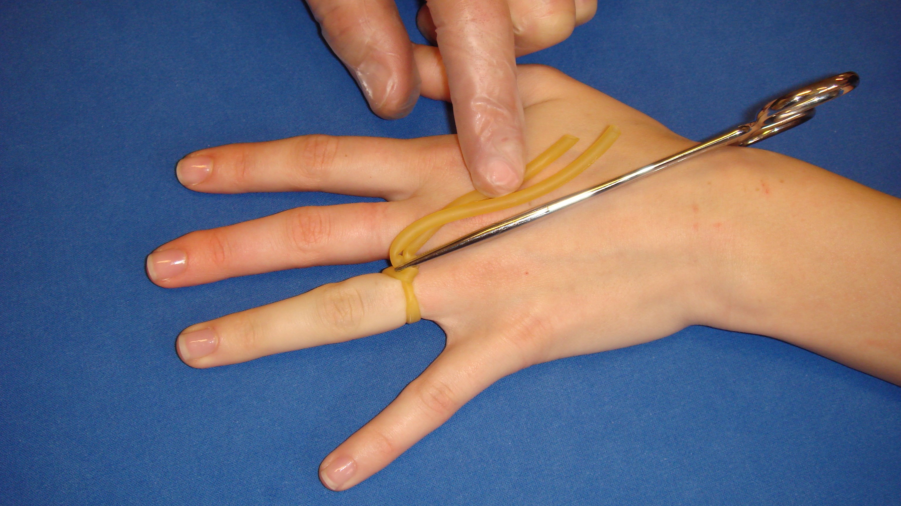 Blodtomt fält anlagt, notera blekheten i fingret. Stasslangen förs runt fingret, en peang används för att klämma över slangarna.