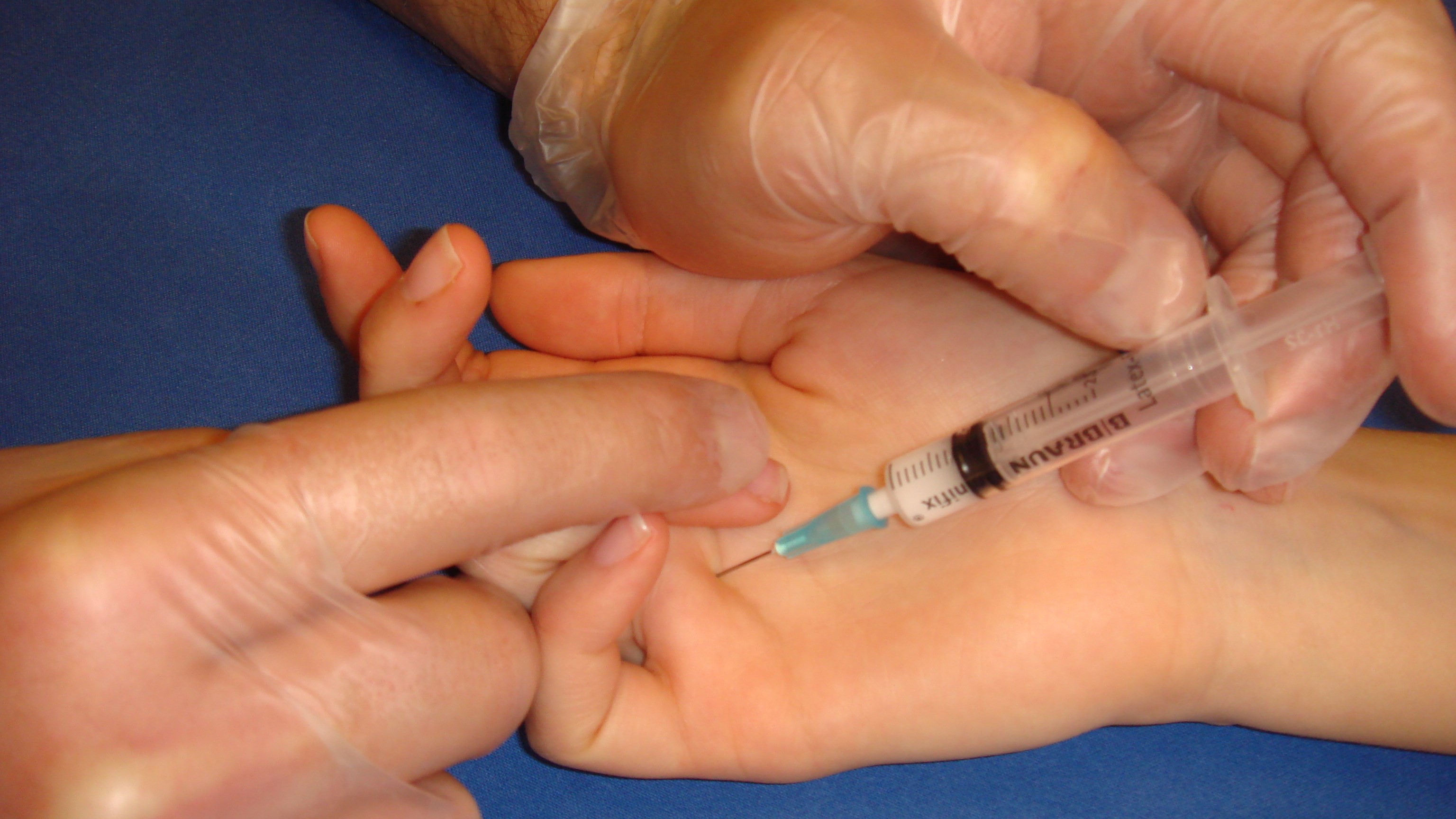 Låg ulnarisblockad (handledsnivå). 3-5 ml 1 % Carbocain injiceras proximalt om os pisiforme radialt om flexor carpi ulnaris (FCU) senan.