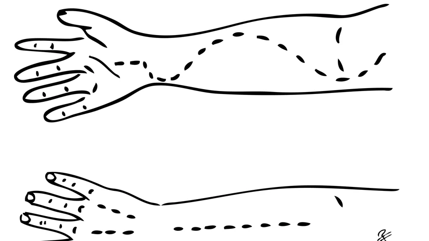 Svart och vitt diagram av kirurgisk fasciotomi