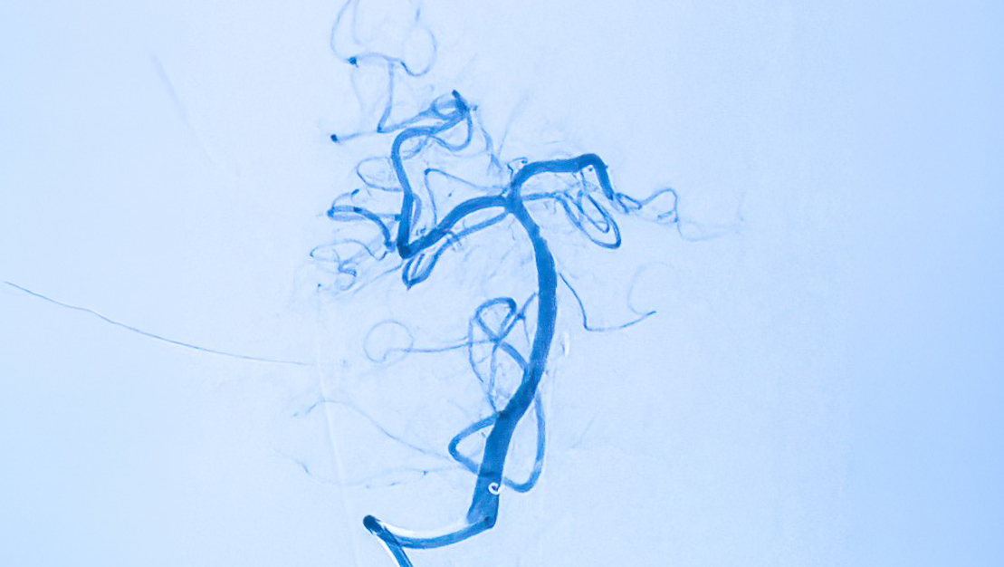 X-ray of a stroke