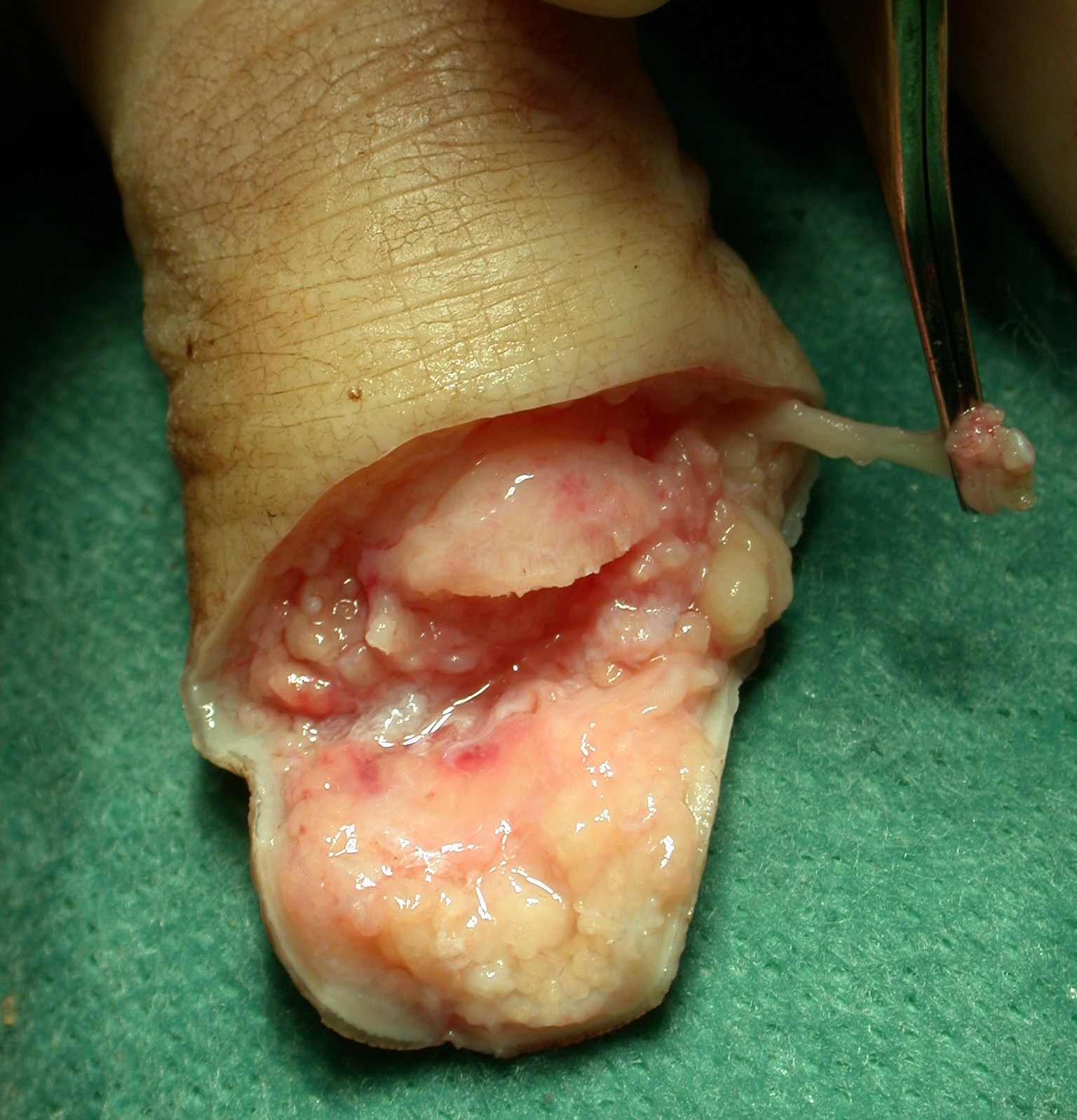 Hudkanterna jämnas till och trimmas till bra kvalité. Digitalnerverna dras ut (m.h.a. peang), kortas och ibland diatermeras - för att minska risken att få neurom lokaliserat till toppen