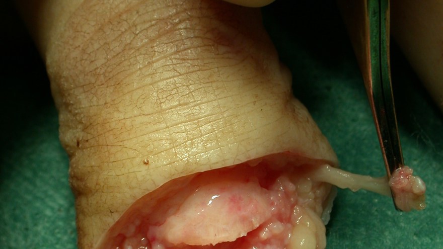 Hudkanterna jämnas till och trimmas till bra kvalité. Digitalnerverna dras ut (m.h.a. peang), kortas och ibland diatermeras - för att minska risken att få neurom lokaliserat till toppen