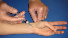 Medianusnerven löper på handledsnivå mellan palmaris longis (PL) och flexor carpi radiais (FCR). Palmaris longus visualiseras lättast hos patienten om denne pressar lillfinger och tumme mot varandra samt lätt flexion i handleden. 3-4 ml 1 % Carbocain injiceras strax under huden.