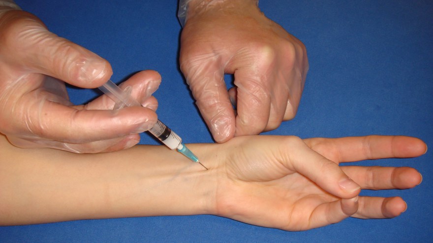 Medianusnerven löper på handledsnivå mellan palmaris longis (PL) och flexor carpi radiais (FCR). Palmaris longus visualiseras lättast hos patienten om denne pressar lillfinger och tumme mot varandra samt lätt flexion i handleden. 3-4 ml 1 % Carbocain injiceras strax under huden.