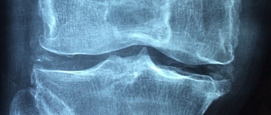 Röntgenbild på en knäled.