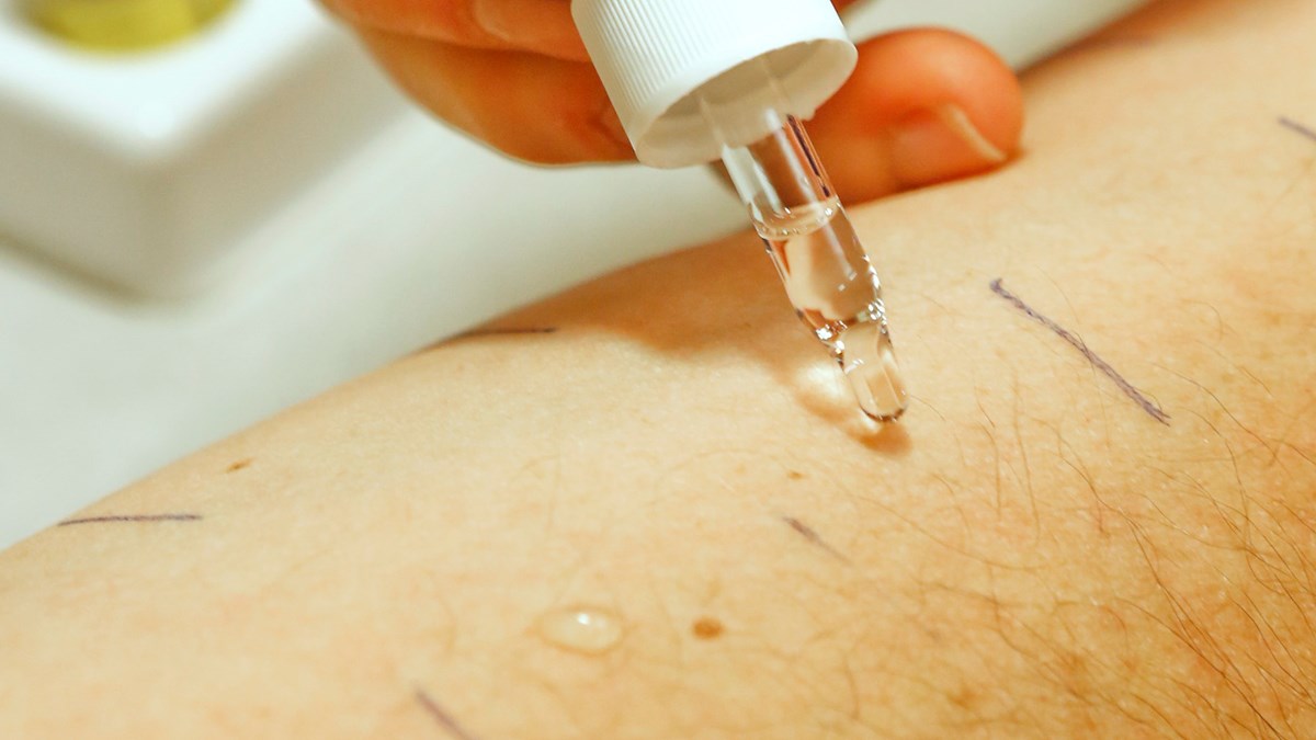 Ett pricktest utförs på en patients underarm, där en droppe av olika allergiframkallande ämnen läggs på huden. Målade bläckstreck särskiljer de olika ämnena.