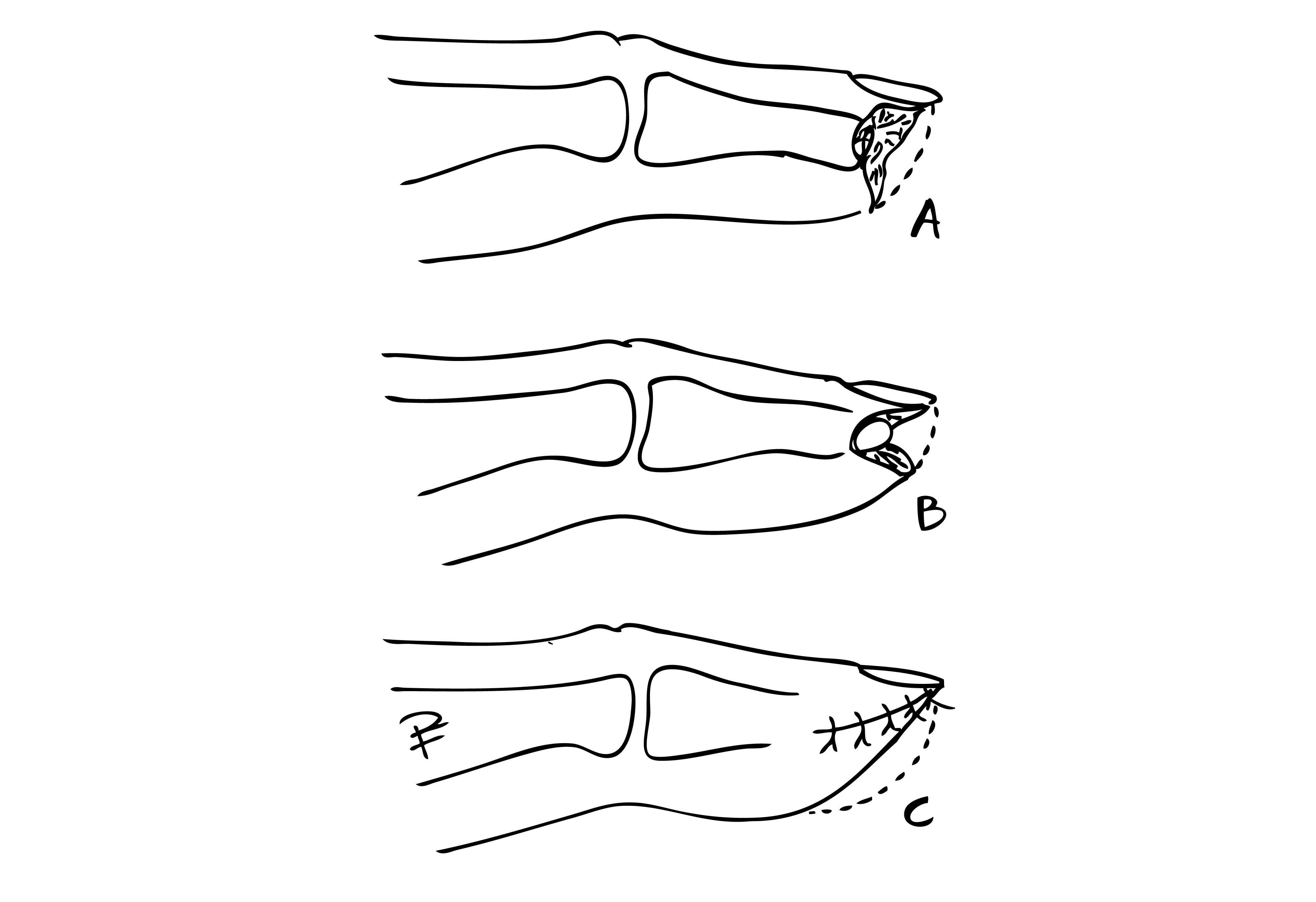 Illustration i svart och vit över fingertoppsskador, tecknat av Per Fredrikson