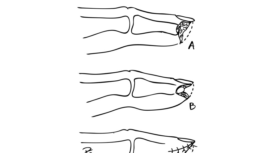 Illustration i svart och vit över fingertoppsskador, tecknat av Per Fredrikson