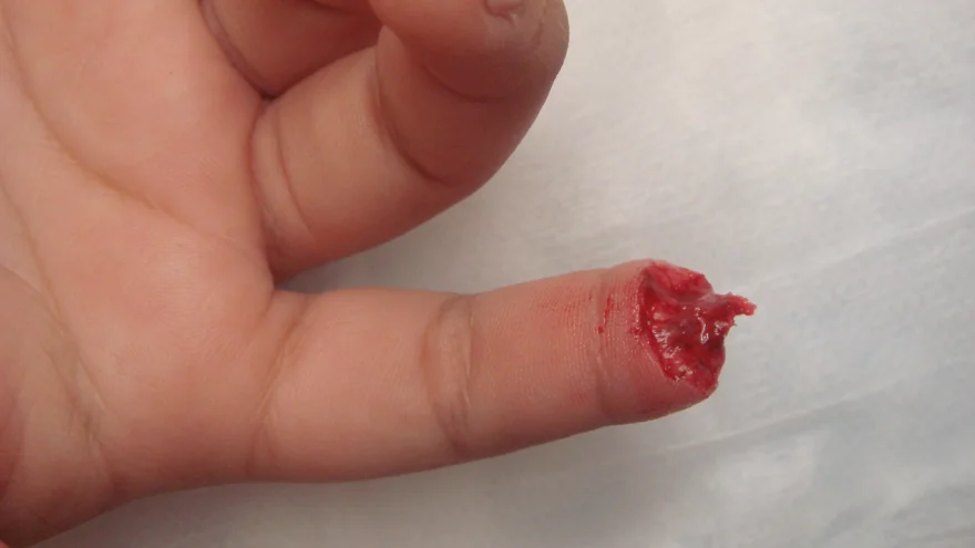 Här en bild på amputerad fingertopp med utstickande ben. Ett tydligt exempel på där benet måste kortas!
