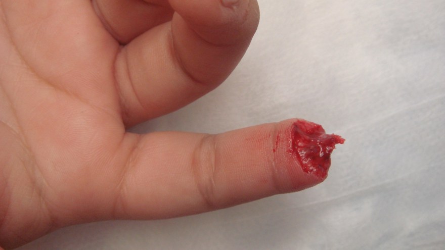 Här en bild på amputerad fingertopp med utstickande ben. Ett tydligt exempel på där benet måste kortas!