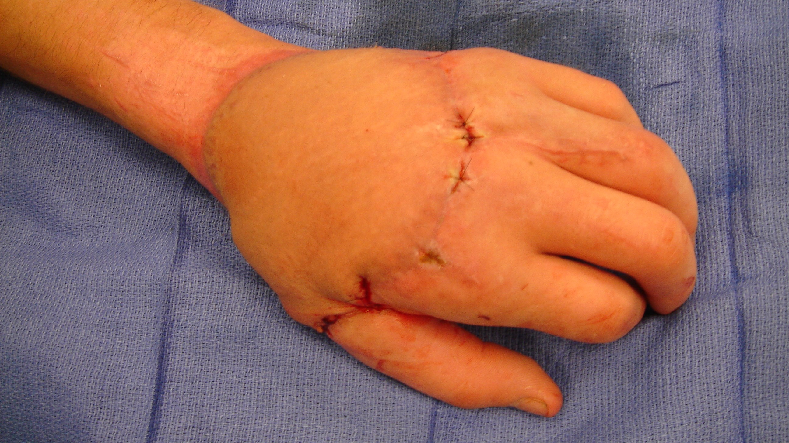 Resultat efter ca 4 veckor, ytterligare förbättring kommer ske över tid