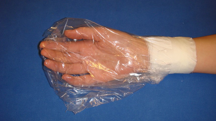 Initialt skede med vätskande ytor används plastpåse som sluts mot underarmen med bandage och tejp.