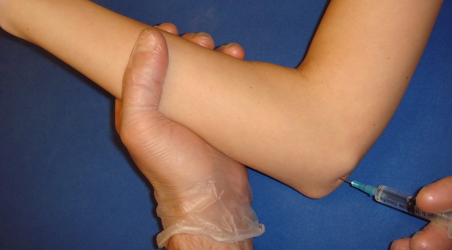 Hög ulnarisblockad (armbågsnivå) Ulnarisnerven palperas proximalt om mediala apikondylen. Nålläget verifieras genom parestesier i handen. 5 ml 1 % Carbocain instilleras runt nerven.