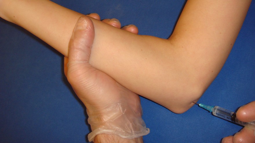 Hög ulnarisblockad (armbågsnivå) Ulnarisnerven palperas proximalt om mediala apikondylen. Nålläget verifieras genom parestesier i handen. 5 ml 1 % Carbocain instilleras runt nerven.