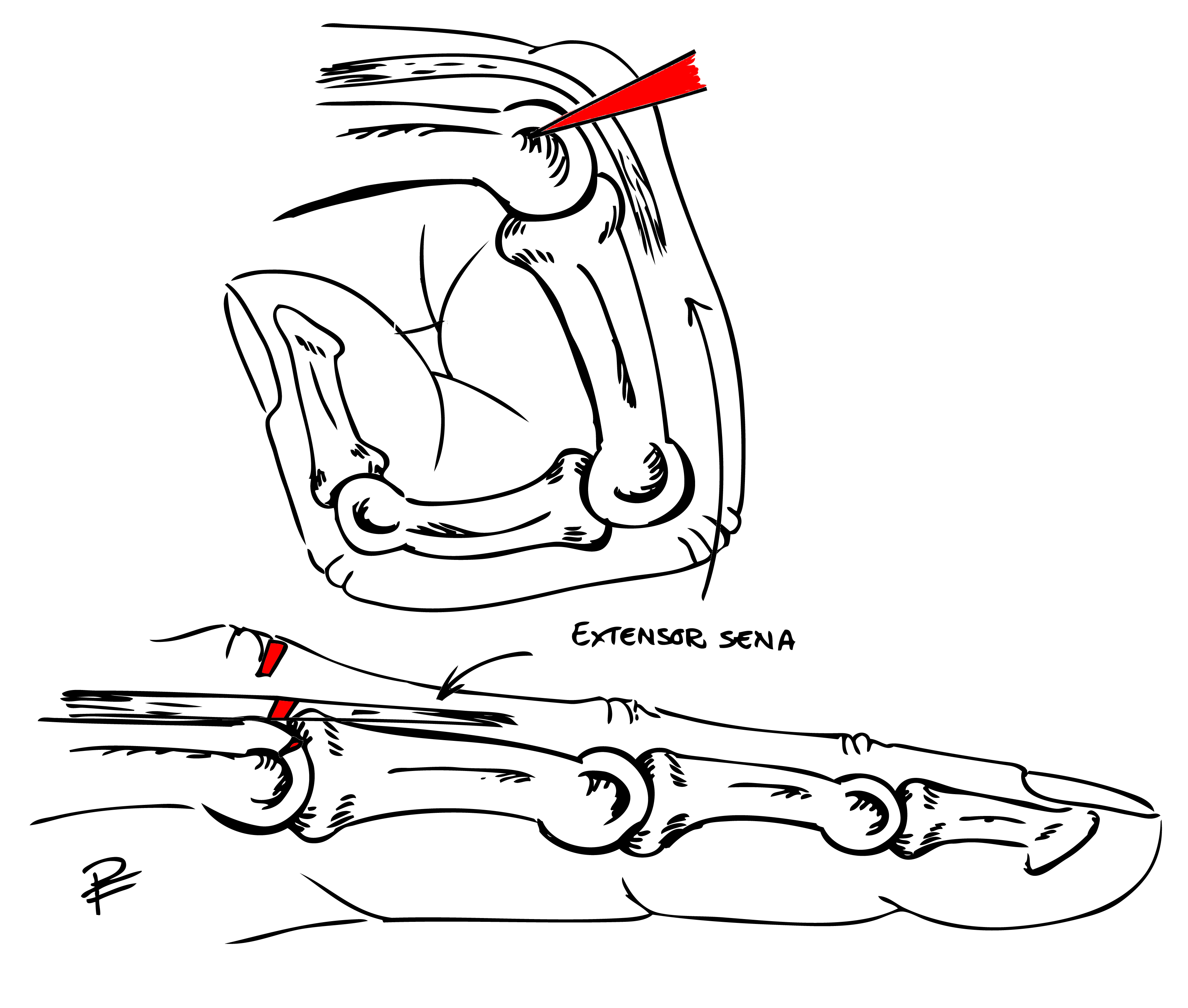 Svart och vit schematisk bild över trauma mot knuten näve. Överst i bild visar det penetrerande föremålets väg (rött) in i leden, vid t.ex. slag mot tand, engagerande hud, sena och brosk.  Nedre bilden visar hur vävnaderna förskjuts när fingret rätas ut viket leder till att möjligheten till dränering försvinner, ”infektionshärden stängs inne”.