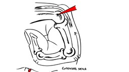 Svart och vit schematisk bild över trauma mot knuten näve. Överst i bild visar det penetrerande föremålets väg (rött) in i leden, vid t.ex. slag mot tand, engagerande hud, sena och brosk.  Nedre bilden visar hur vävnaderna förskjuts när fingret rätas ut viket leder till att möjligheten till dränering försvinner, ”infektionshärden stängs inne”.