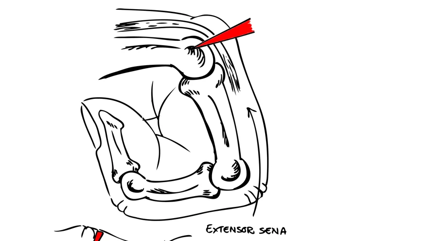 Svart och vit schematisk bild över trauma mot knuten näve. Överst i bild visar det penetrerande föremålets väg (rött) in i leden, vid t.ex. slag mot tand, engagerande hud, sena och brosk. Nedre bilden visar hur vävnaderna förskjuts när fingret rätas ut viket leder till att möjligheten till dränering försvinner, ”infektionshärden stängs inne”.