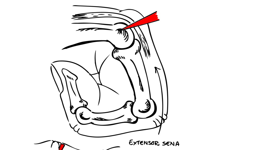 Svart och vit schematisk bild över trauma mot knuten näve. Överst i bild visar det penetrerande föremålets väg (rött) in i leden, vid t.ex. slag mot tand, engagerande hud, sena och brosk. Nedre bilden visar hur vävnaderna förskjuts när fingret rätas ut viket leder till att möjligheten till dränering försvinner, ”infektionshärden stängs inne”.