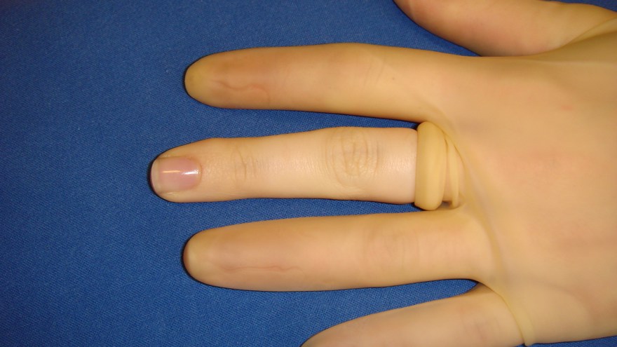 Handsken rullas sedan upp på fingret.