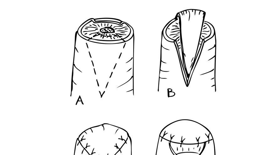 Illustration i svart och vit över V till Y plastik, tecknat av Per Fredrikson