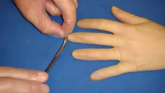Steril handske förs på patientens hand. Ett mycket litet hål klipps i toppen på det finger som man önskar erhålla blodtomt fält på.