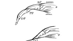 Svart6 och vit bild över mekanism bakom svanhalsdeformitet. Övre bilden: Normaltillstånd där extrinsic och extrinsic muskulatur samverkar. Nedre bilden: Svanhalsdeformitet, här råder alltså obalans mellan extrinsic och intrinsic muskulatur där intrinsic är för kontraherad. Detta resulterar i en översträckt PIP-led och en flekterad MCP-led.