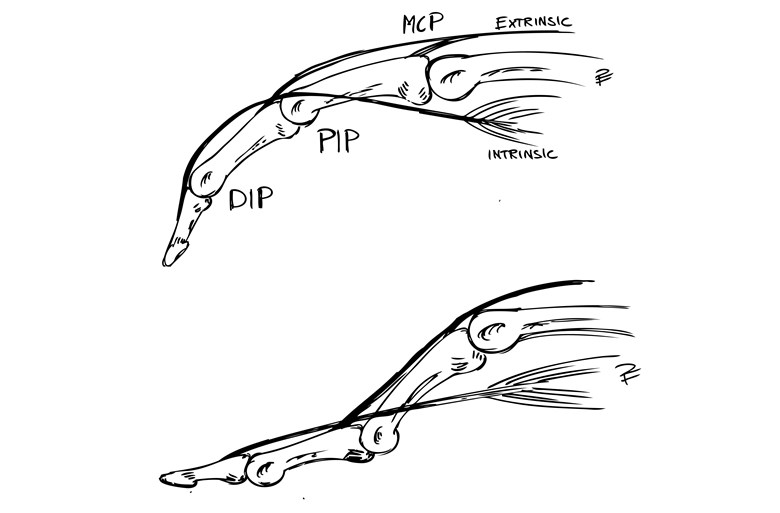 Svart6 och vit bild över mekanism bakom svanhalsdeformitet. Övre bilden: Normaltillstånd där extrinsic och extrinsic muskulatur samverkar. Nedre bilden: Svanhalsdeformitet, här råder alltså obalans mellan extrinsic och intrinsic muskulatur där intrinsic är för kontraherad. Detta resulterar i en översträckt PIP-led och en flekterad MCP-led.