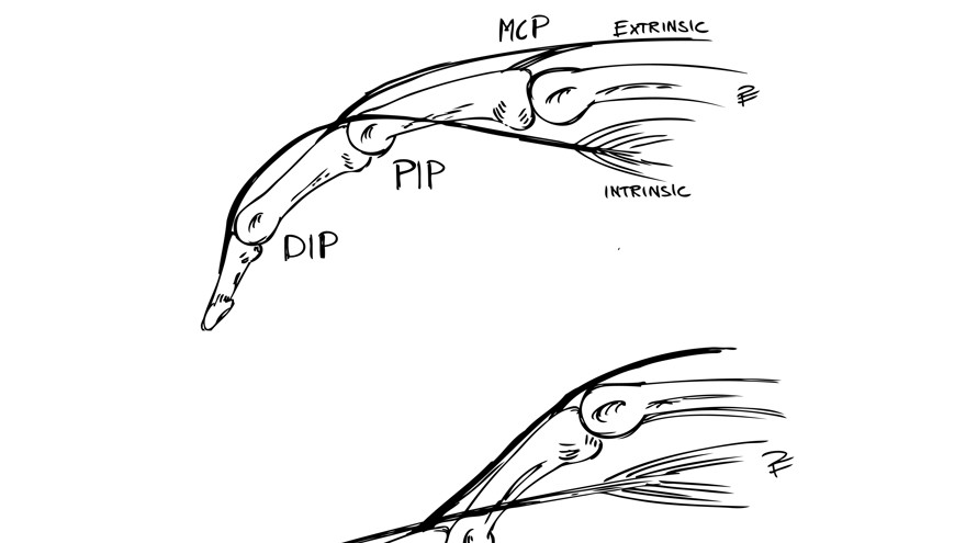 Svart6 och vit bild över mekanism bakom svanhalsdeformitet. Övre bilden: Normaltillstånd där extrinsic och extrinsic muskulatur samverkar. Nedre bilden: Svanhalsdeformitet, här råder alltså obalans mellan extrinsic och intrinsic muskulatur där intrinsic är för kontraherad. Detta resulterar i en översträckt PIP-led och en flekterad MCP-led.