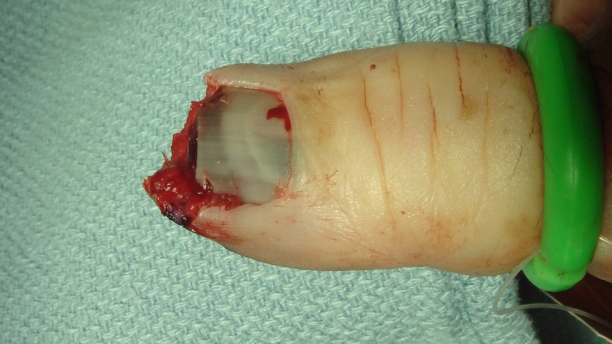 Blodtomt fält erhålles här genom åtstramande ring