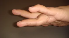 svanhalsdeformitet