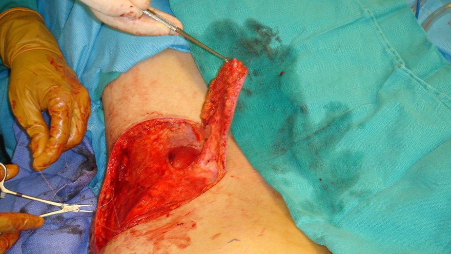 Ljumsklambå skapas från vänster höft