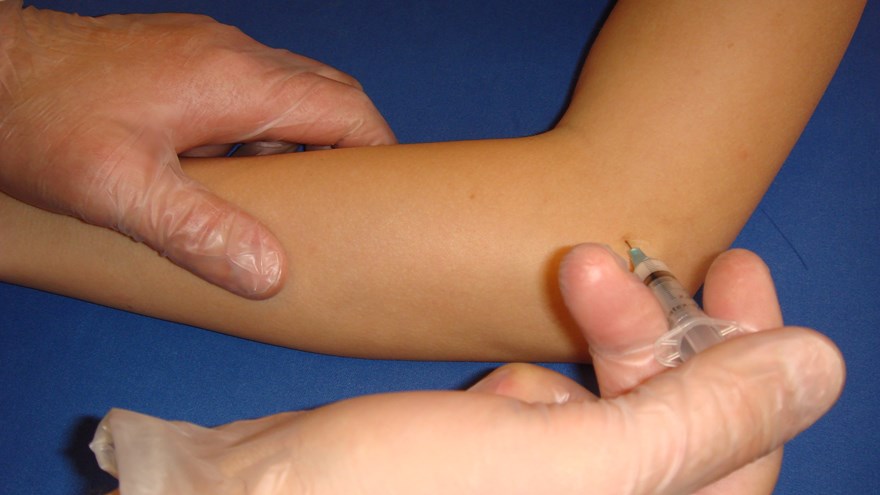 Injektionen sker direkt i/under sträckmuskulaturens senfäste vid den laterala epikondylen.