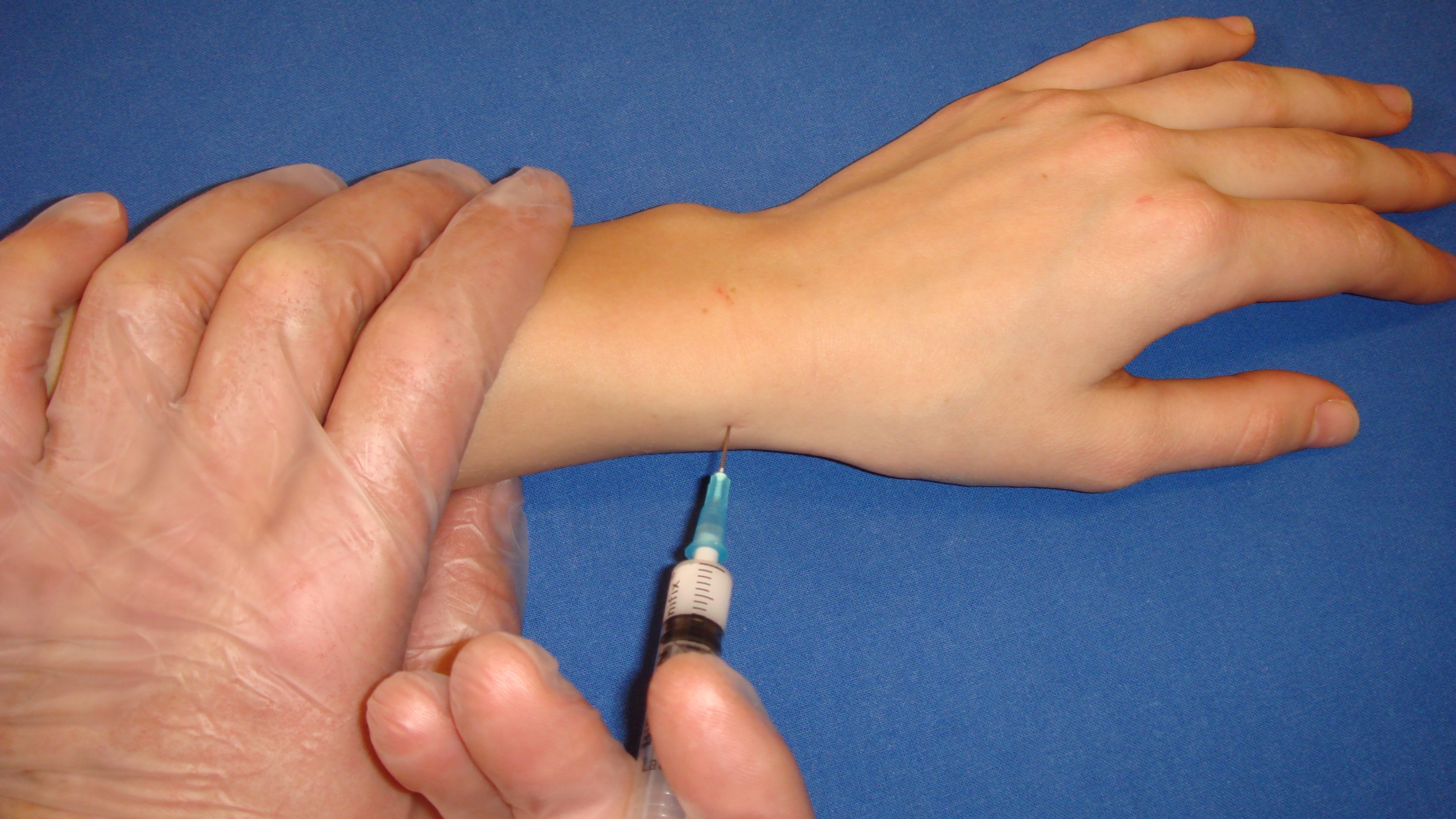 3-4 ml 1 % Carbocain infiltreras subcutant i höjd med processus styloideus radii.