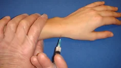 3-4 ml 1 % Carbocain infiltreras subcutant i höjd med processus styloideus radii.