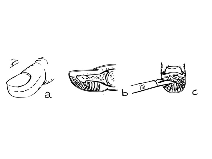 Schematisk teckning över tillvägagångssättet för terapeutisk incision. Planerad snittföring (a), septa i genomskärning (b) teknik för öppnande av infekterade septa med skalpell (c).