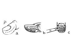 Schematisk teckning över tillvägagångssättet för terapeutisk incision. Planerad snittföring (a), septa i genomskärning (b) teknik för öppnande av infekterade septa med skalpell (c).
