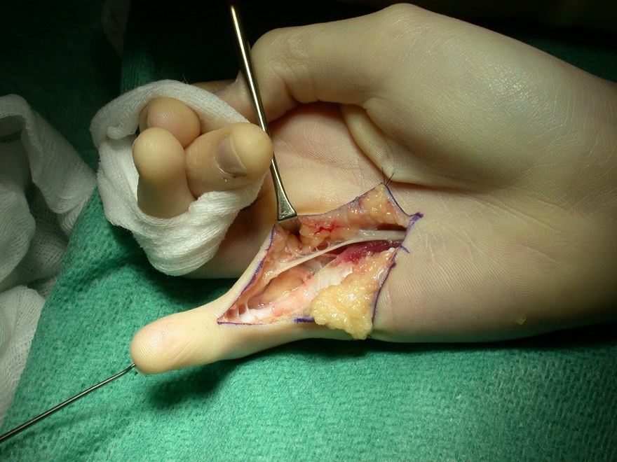 Bild som visar en operation av flexorsenskada i zon II.